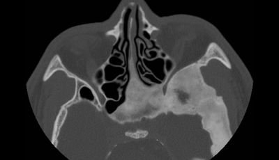 Entenda a displasia fibrosa e seus principais sinais