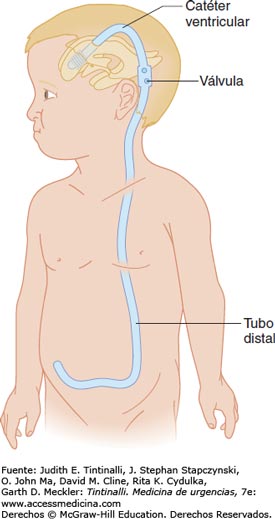 entenda os sistemas de derivacao ventriculo peritoneal 01